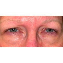 Quad Blepharoplasty Before & After Patient #304