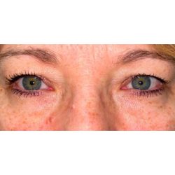 Quad Blepharoplasty Before & After Patient #302