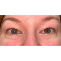 Quad Blepharoplasty Before & After Patient #300