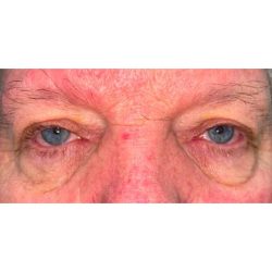 Quad Blepharoplasty Before & After Patient #299
