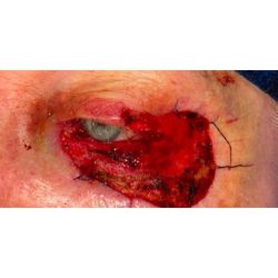 Mohs Repair Before & After Patient #266