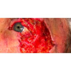 Mohs Repair Before & After Patient #259