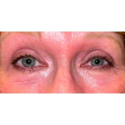 Quad Blepharoplasty Before & After Patient #304