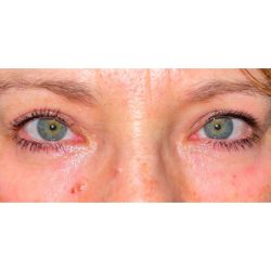 Quad Blepharoplasty Before & After Patient #302