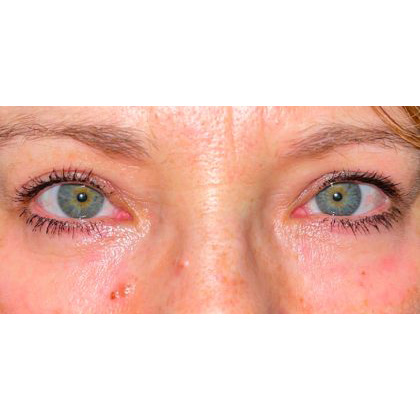 CO2 Laser Resurfacing Before & After Patient #302