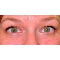 Quad Blepharoplasty Before & After Patient #300