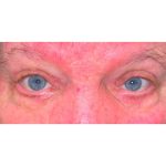 CO2 Laser Resurfacing Before & After Patient #299