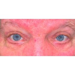 Quad Blepharoplasty Before & After Patient #299
