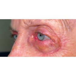 Mohs Repair Before & After Patient #266