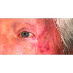 Mohs Repair Before & After Patient #259