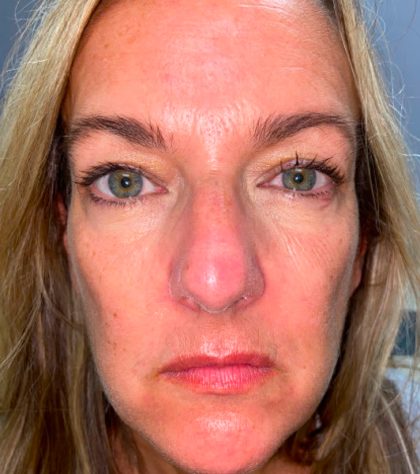 CO2 Laser Resurfacing Before & After Patient #296