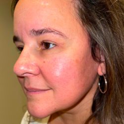 Facelift Before & After Patient #294