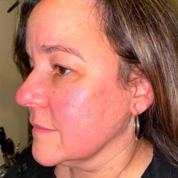 Facelift Before & After Patient #294