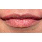 Lip Filler Before & After Patient #298