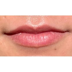 Lip Filler Before & After Patient #298