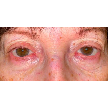 Ptosis Repair Before & After Patient #274