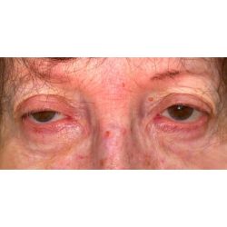 Ptosis Repair Before & After Patient #274