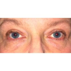 Ptosis Repair Before & After Patient #272