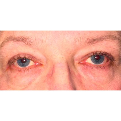 Ptosis Repair Before & After Patient #272