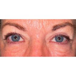 Ptosis Repair Before & After Patient #271
