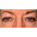 Ptosis Repair Before & After Patient #271