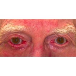 Ectropion Repair Before & After Patient #265