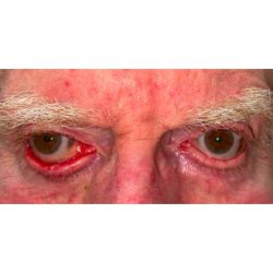 Ectropion Repair Before & After Patient #265