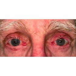 Entropion Repair Before & After Patient #264