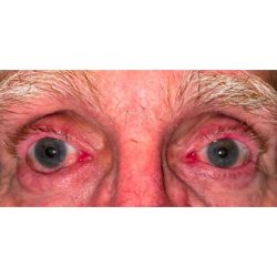 Entropion Repair Before & After Patient #264