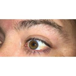 Lesion Removal Before & After Patient #262