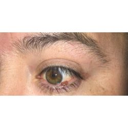 Lesion Removal Before & After Patient #262