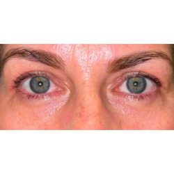 Upper Blepharoplasty Before & After Patient #281