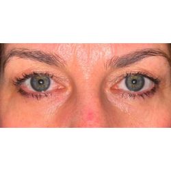 Upper Blepharoplasty Before & After Patient #281