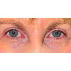 Upper Blepharoplasty Before & After Patient #280