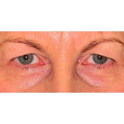 Upper Blepharoplasty Before & After Patient #280