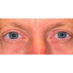 Upper Blepharoplasty Before & After Patient #279