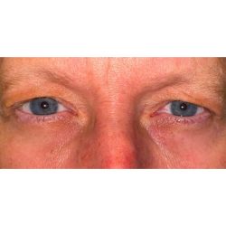 Upper Blepharoplasty Before & After Patient #279