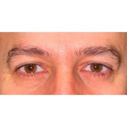 Upper Blepharoplasty Before & After Patient #277