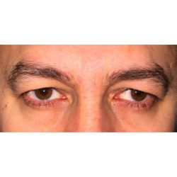 Upper Blepharoplasty Before & After Patient #277