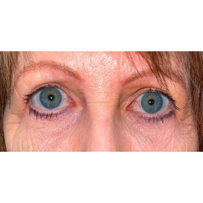Ptosis Repair Before & After Patient #276