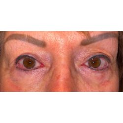 Ptosis Repair Before & After Patient #625