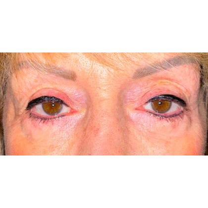 Ptosis Repair Before & After Patient #625