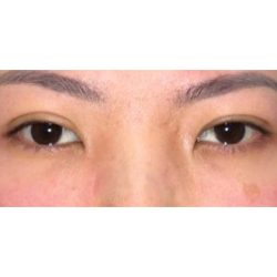 Orbital Decompression Before & After Patient #289