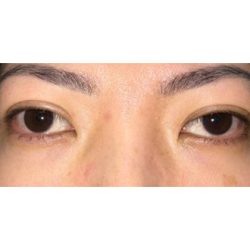 Orbital Decompression Before & After Patient #289
