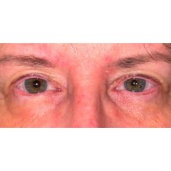 Orbital Tumor Removal Before & After Patient #284