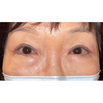 Double Eyelid Surgery Before & After Patient #342