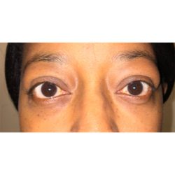 Orbital Decompression Before & After Patient #828