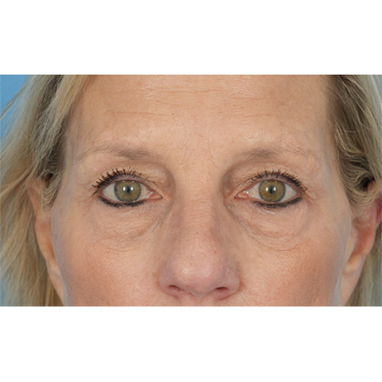 Four Lid Blepharoplasty Before & After Patient #400