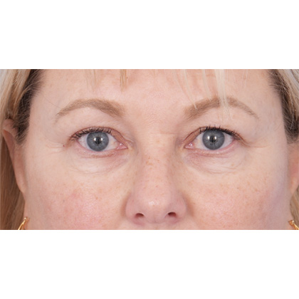 Four Lid Blepharoplasty Before & After Patient #416