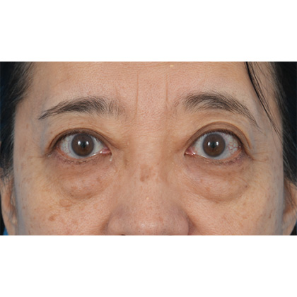 Lower Blepharoplasty Before & After Patient #521